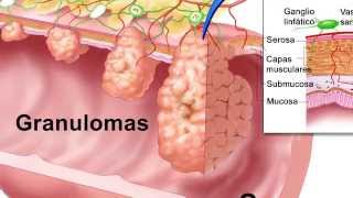 To be or Not be Sarcoidosis [upl. by Weig487]