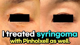 Successfully treated recurring syringomas resistant to laser treatment using Pinholxell method [upl. by Zannini]