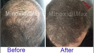 I’ve Used Minoxidil For 10 Years  Here Are The Results hair [upl. by Einoj975]