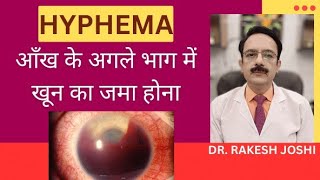 Hyphema  Blood in eye [upl. by Ennyletak]