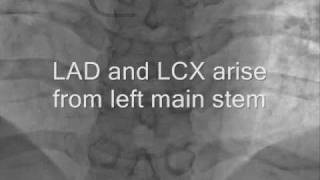 Coronary Angiogram in Patient with Dextrocardia [upl. by Moorefield416]