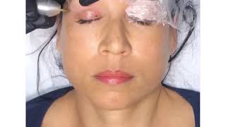 Plasma fibroblast eyelid lift video and results [upl. by Profant32]