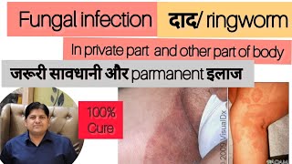 दाद का परमानेंट इलाज  Fungal Infection in Private Parts  सावधानी  Homeopathic Treatment Medicine [upl. by Jeane]