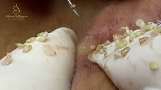 Loan Nguyen Acne Treatment 16477 [upl. by Saxen]