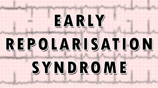 Early Repolarization Syndrome [upl. by Ellasal]