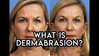 Dermabrasion [upl. by Loresz]