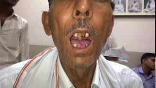 BULBAR PALSY PATIENT WITH TONGUE FASICULATIONS [upl. by Felicdad]