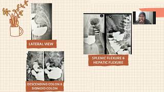 Barium enema Case Study [upl. by Jasmina]