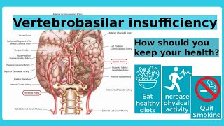 vertebrobasilar insufficiency [upl. by Roede]