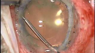 Baseer U Khan MD Dislocated Cataract Extraction CTS Iridodialysis Repair and Pupil Cerclage [upl. by Eibrad]