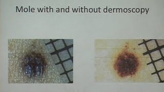 Melanoma and Nonmelanoma Skin Cancer [upl. by Scarlet]