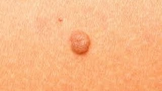 How to Remove Skin Tags at Home DermTVcom Epi 511 [upl. by Tiernan342]