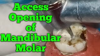 Access opening of mandibular first molar  First step of RCT [upl. by Biancha]