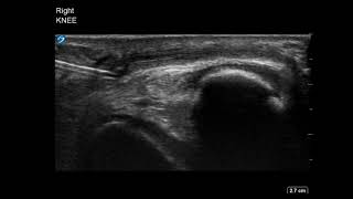 Knee Ultrasound Infrapatellar Bursitis Injection Part 4 [upl. by Gorman]