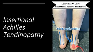 Insertional Achilles Tendinopathy [upl. by Church]