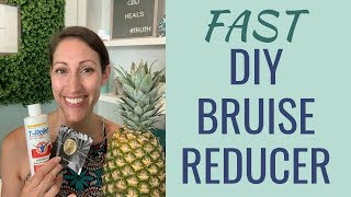 DIY Natural Bruise Treatment  How to Get Rid of a Bruise Fast  Best Home Remedy for Bruises [upl. by Vicki655]