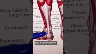 Insertional Achilles Tendonitis [upl. by Enerol222]