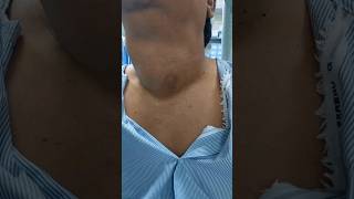 THYROID GOITER patient from TIRUPATI  kya hum unki thyroid SURGERY ko rok sake thyroidnodule [upl. by Sandell]