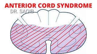 Anterior Cord Syndrome  Anterior Spinal Artery Syndrome [upl. by Hercule]