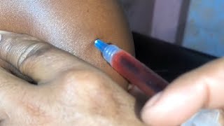 How to give an Im Intramuscular injection in the Buttocks Vitamins B1 B6 B12 injection video [upl. by Ainek]