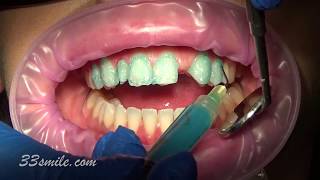 porcelain dental veneer bridge and veneers cosmetic dentistry before and after [upl. by Atihcnoc903]