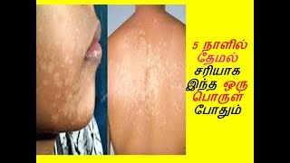 தேமல் சரியாக  Themal Maraya tips  REMOVE WHITE PATCHES IN 5 DAYS [upl. by Mandler]