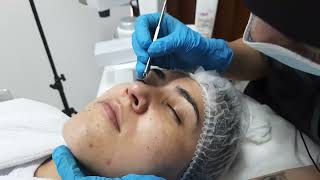 Limpieza facial profunda  Vitti medical  cuidado facial  tratamientos faciales [upl. by Klute]