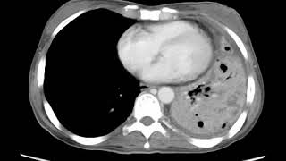 Necrotizing pneumonia Axial CECT Essential Radiology for Medical Students Interns and Residents [upl. by Orton403]