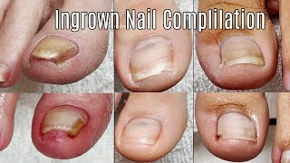 Ingrown Toenail Cleaning Compilation [upl. by Leaper]