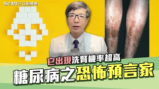 糖尿病恐怖預言家！拉褲管一看驚見「糖斑」醫師揭密糖尿病併發症 它一出現洗腎機率超高！冠心病、視網膜病變、糖尿病足通通來超強5招逆轉 糖尿病脛前黑斑｜腎寶思樂腎臟專科｜祝你健康 [upl. by Gurias456]