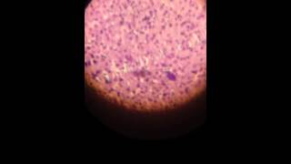 Schizont of malaria in the liver [upl. by Aihtnis]