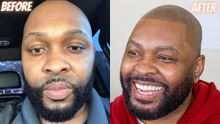 WATCH THIS Scalp Micropigmentation Review in Houston TX [upl. by Leggat]