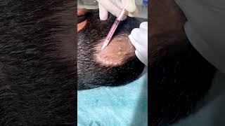 Alopecia Areata Treatment For Hair Growth  Treatment Of Alopecia  Skinaa Clinic shorts viral [upl. by Milburr]