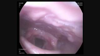 HD Flexible Scope  Hoarseness [upl. by Kristine]