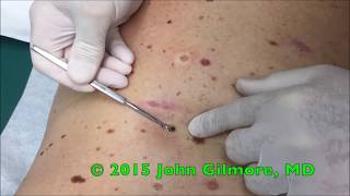 Multiple Dilated Pores  Blackhead Extractor [upl. by Norma]