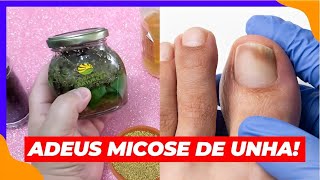 Adeus micose de unha Receita caseira simples e eficaz para eliminar a infecção [upl. by Gentry570]