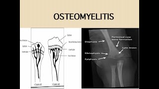 Acute Osteomyelitis [upl. by Gelasias135]