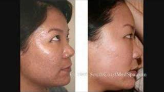 Laser Acne Scar Removal Treatment  Asian Patient [upl. by Rollet]