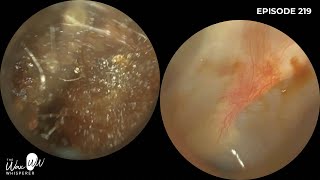 220  Difficult Ear Wax Removal in Narrow Ear with the WAXscope [upl. by Adlar]