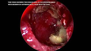 Fungal ball in Sphenoid sinus with erosion of skull base [upl. by Dunseath554]