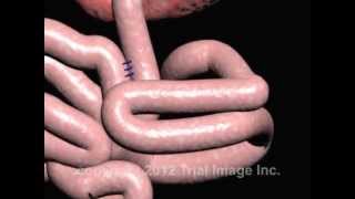 Intussusception of the Bowel video  Animation by Cal Shipley MD [upl. by Ecinehs]