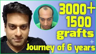 Hair Transplantation Result in 6 Years 4500 DHTFUE grafts NW 34 at 6 years Drs SethiBansal [upl. by Leonard]