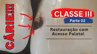 Restauração Classe III  Parte 02  Acesso Palatal [upl. by Anidam513]