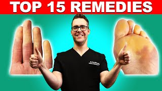 Raynauds Syndrome Top 15 Remedies Symptoms amp Best Treatment [upl. by Kristi]