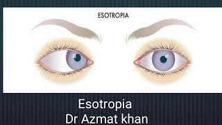 Esotropia its classifications and management Part 12 [upl. by Hajile]