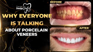 Why Everyone is Talking About Porcelain Veneers [upl. by Smalley]