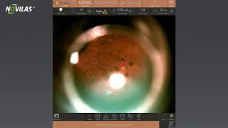 Navilas® Laser Peripheral Iridotomy Treatment [upl. by Enitsed456]