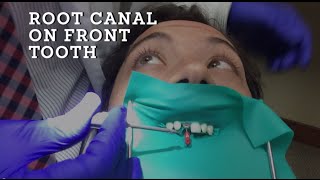 Root Canal Treatment Demonstration A how to procedure on Front Tooth in HD [upl. by Esiahc]