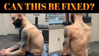 SEVERE Scoliosis  Kyphosis amp Chiropractic Former Power Lifter Suffers Career Ending Injury [upl. by Elene]