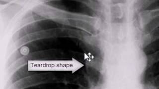 Chest xray Azygos Lobe [upl. by Isabelle]